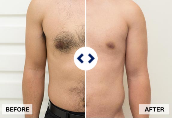 33_medical_hair_removal_mens_clinic03_1