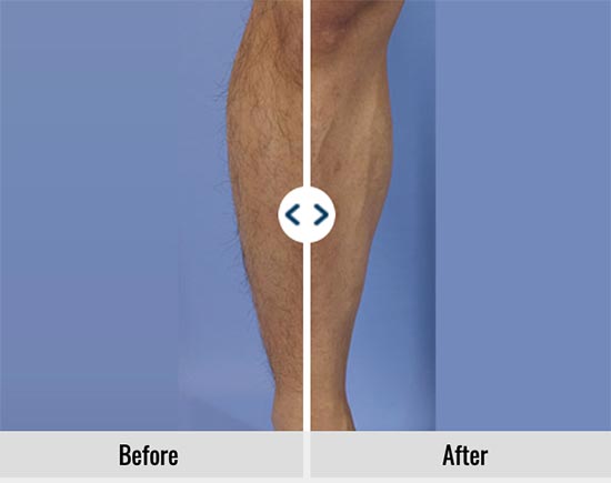 33_medical_hair_removal_mens_clinic11_1