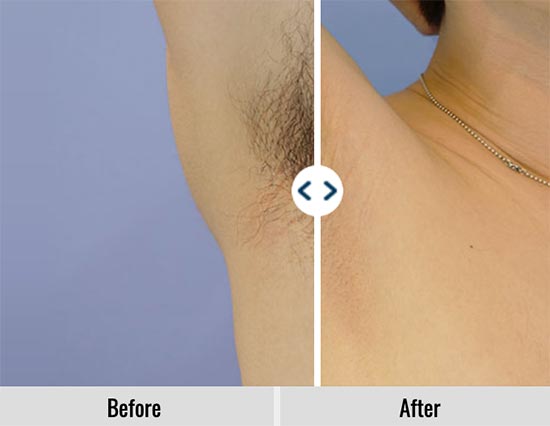 33_medical_hair_removal_mens_clinic11_2